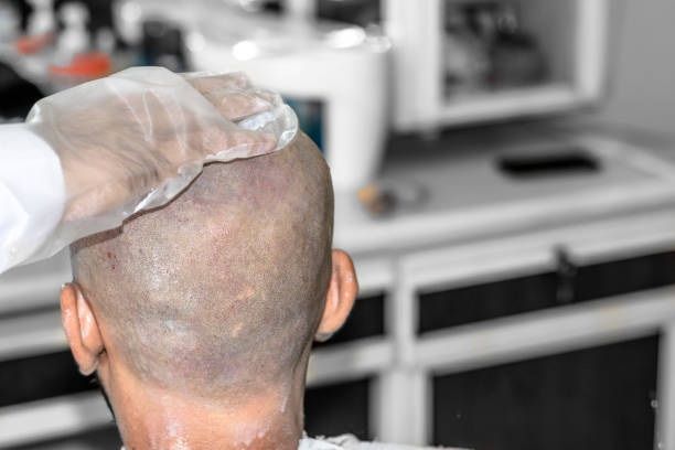Hair Transplant Surgery: Techniques and Results